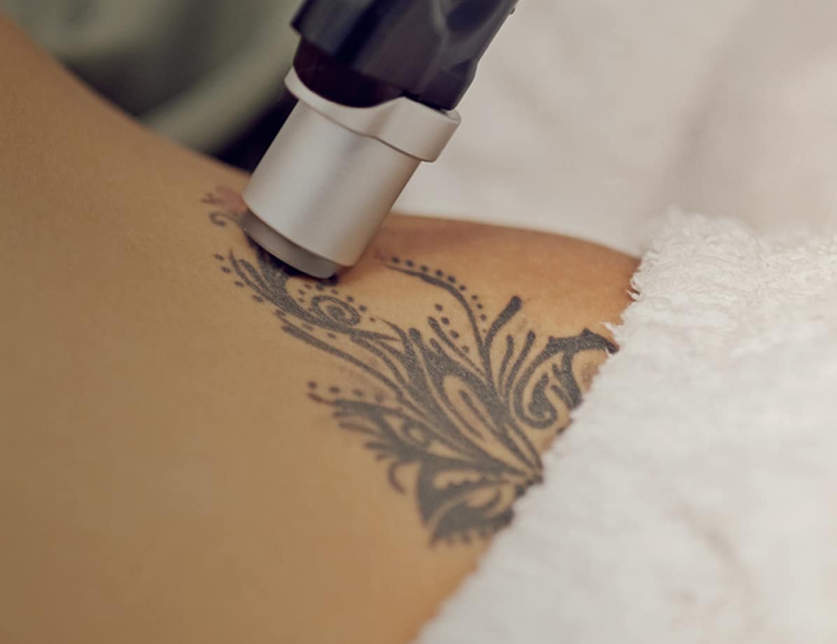 TattooRemoval_Hero_Mobile_New